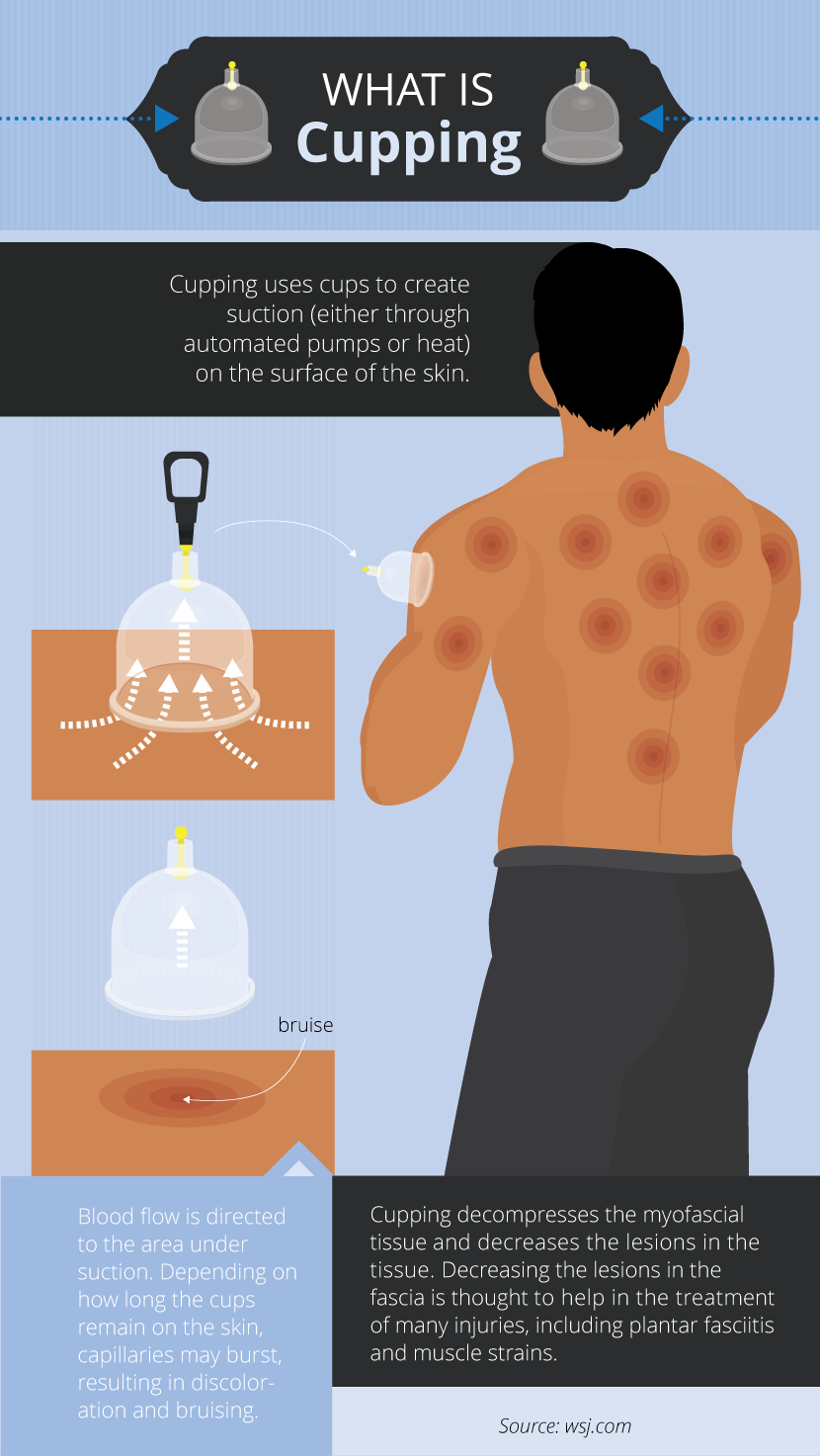 What is Cupping - Alternative Therapies: Benefits and Risks 